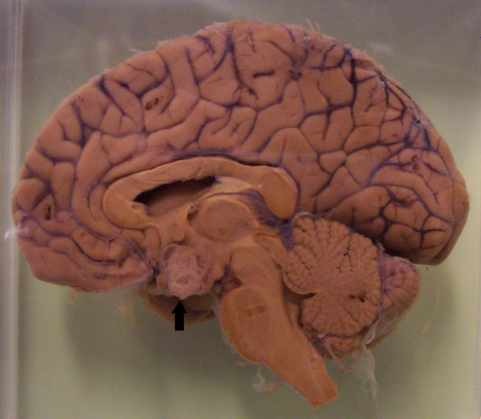 A craniopharyngioma