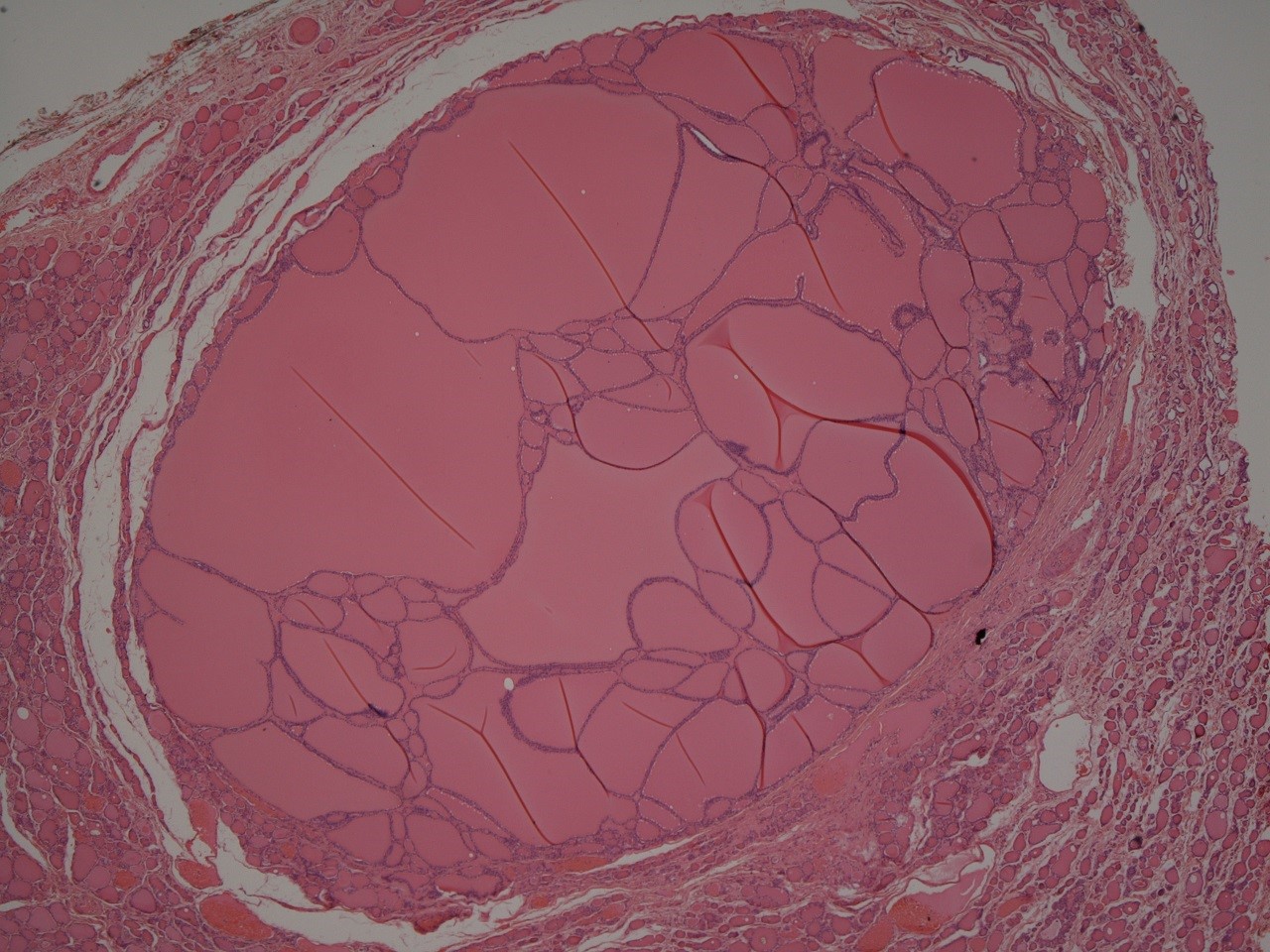 Histology of a multinodular goitre