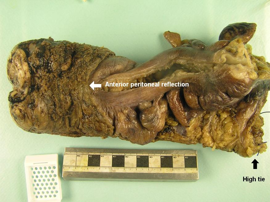 The high tie of an anterior resection specimen
