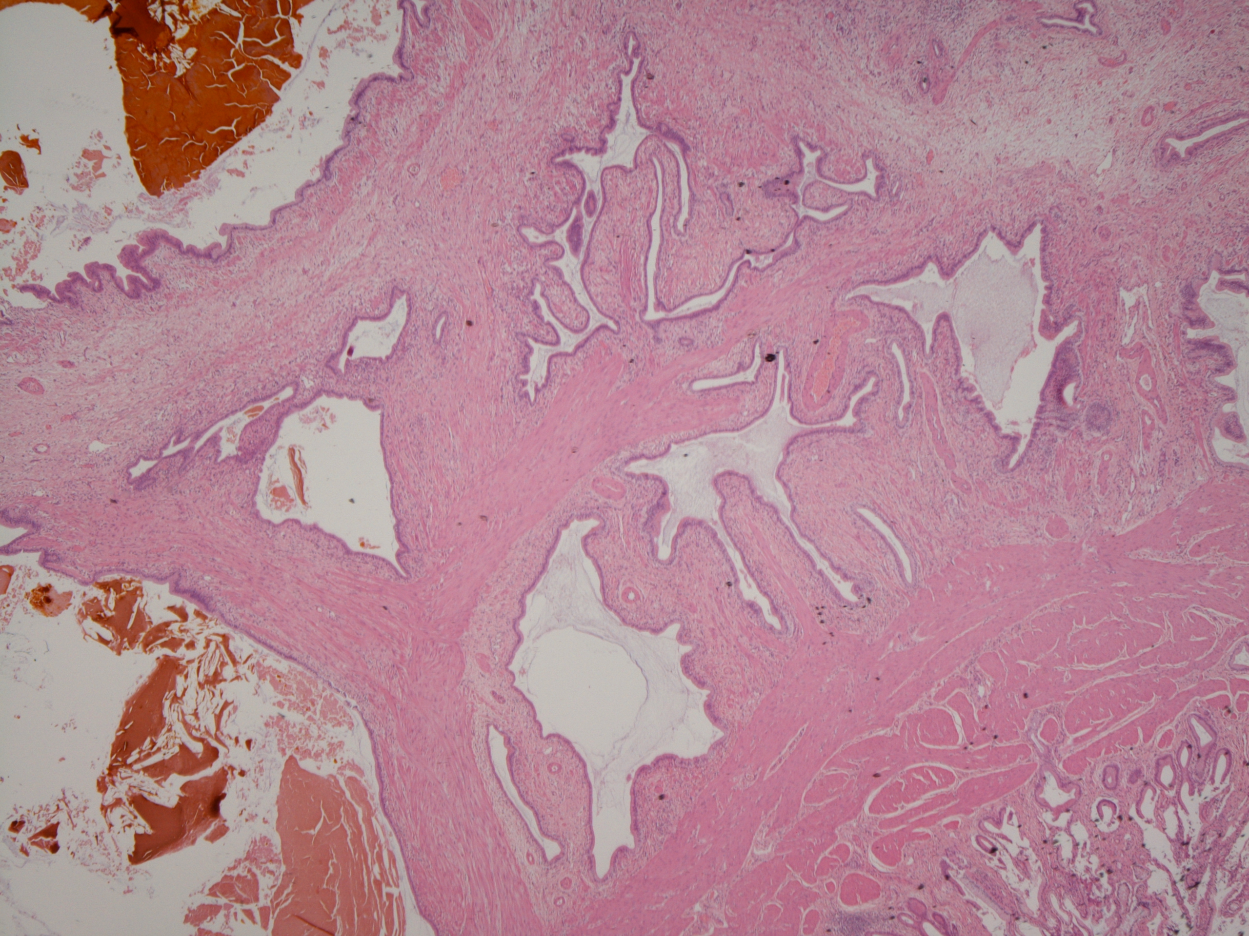 A microscopic image of an adenomyoma