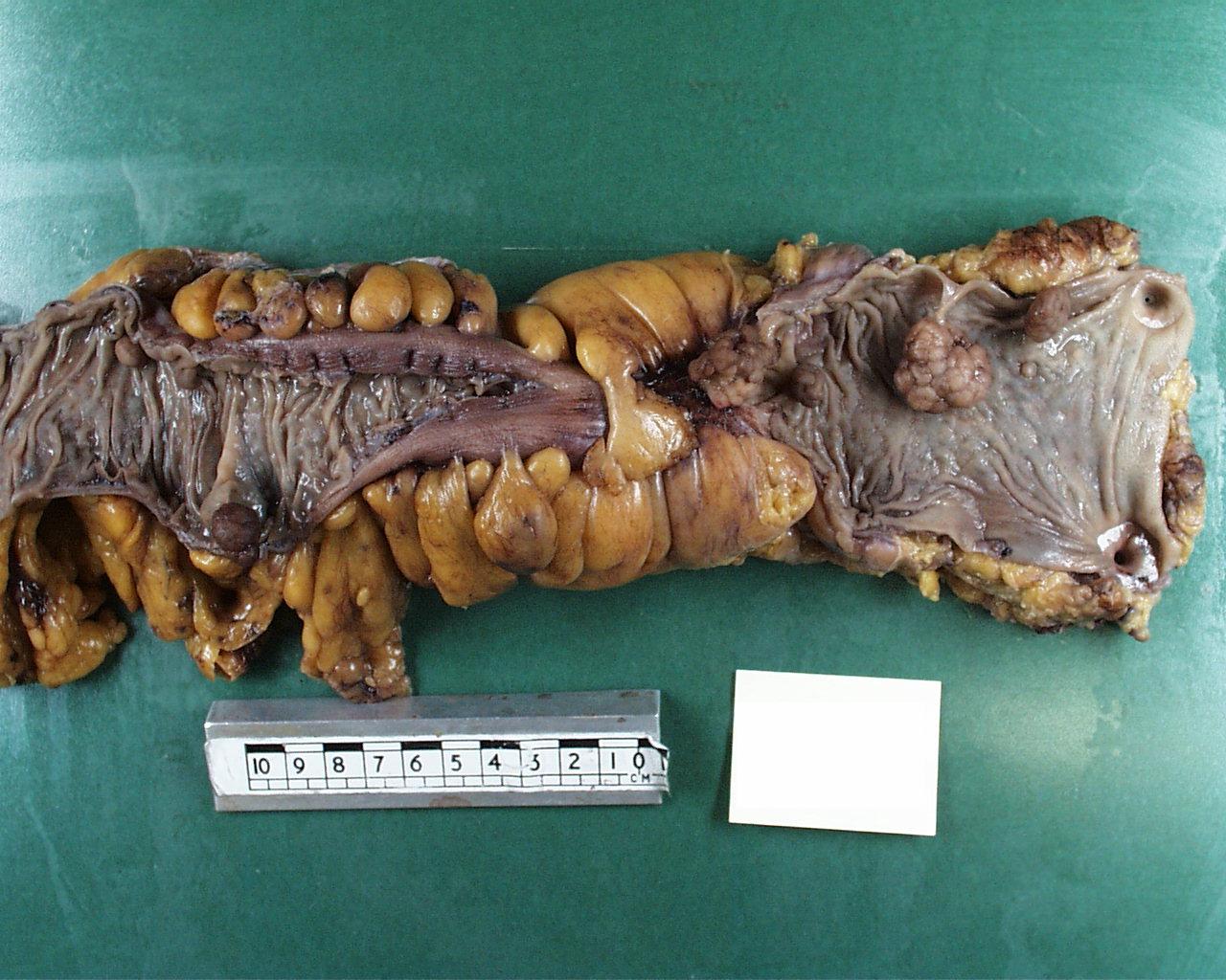 Large bowel specimen after fixation