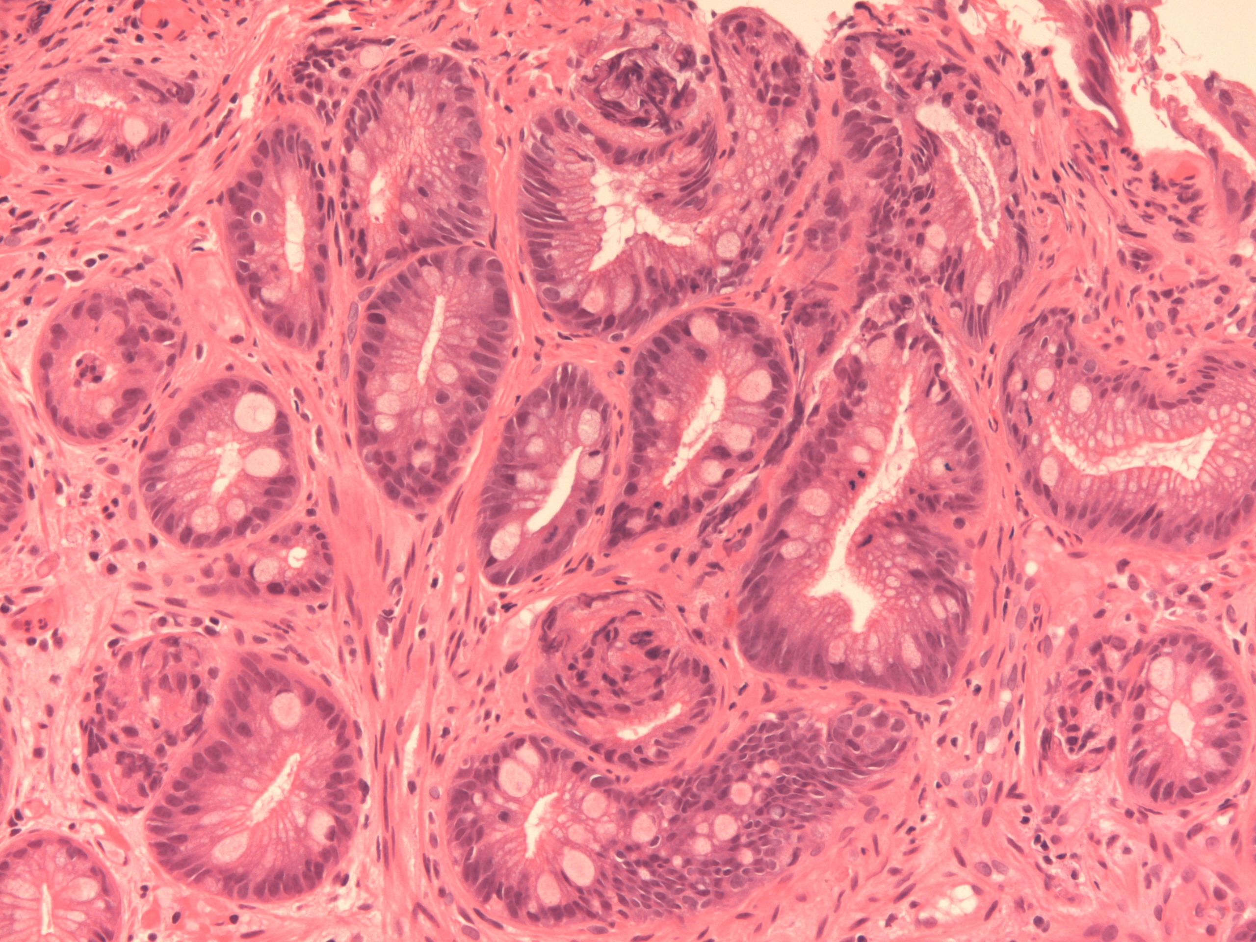 Microscopic image of Barrett's oesophagus
