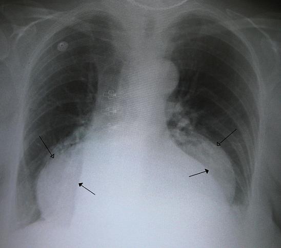 A chest X-ray of a hiatus hernia