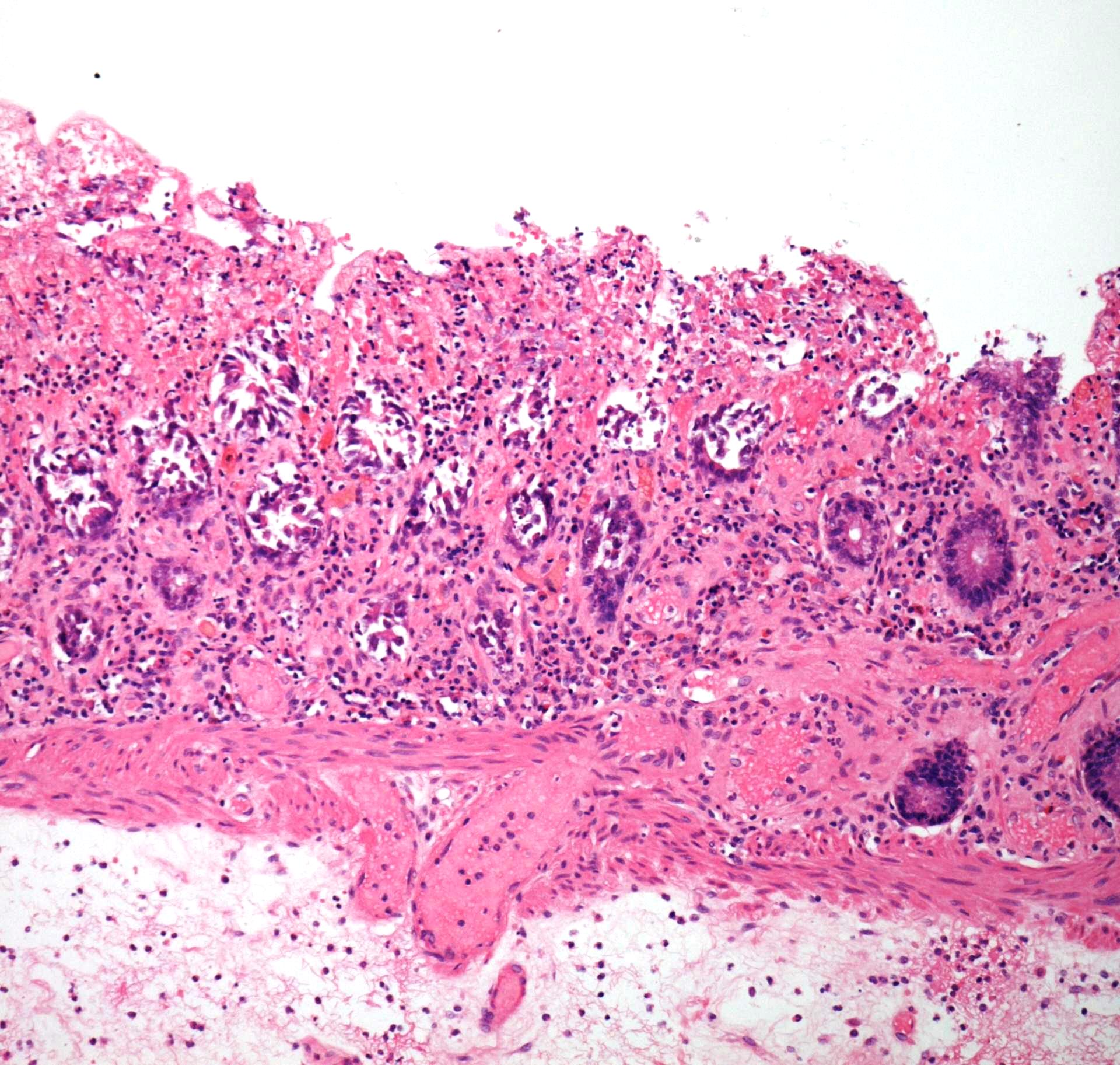 Microscopic image of intestinal ischaemia