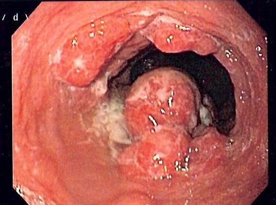 Oesophageal carcinoma