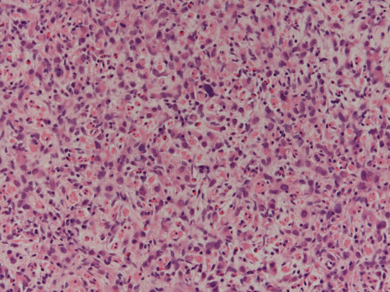 Signet ring cell adenocarcinoma