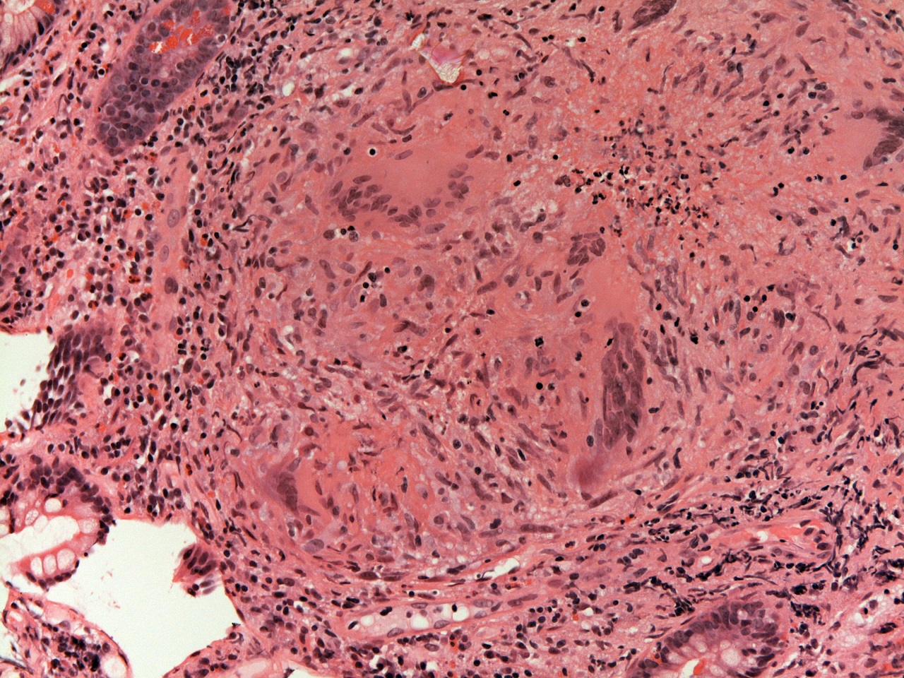Granuloma with giant cell