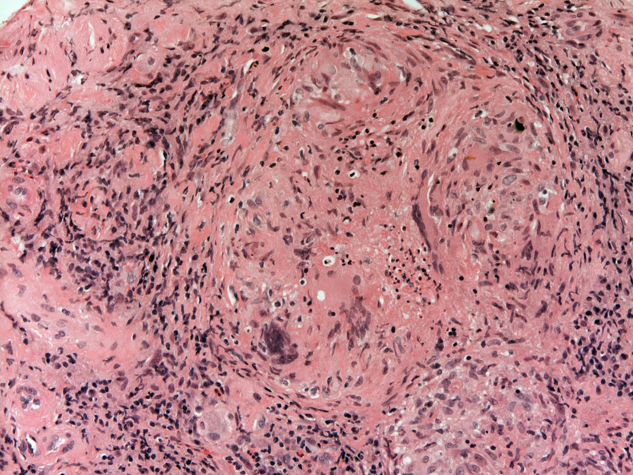 Granuloma with necrosis