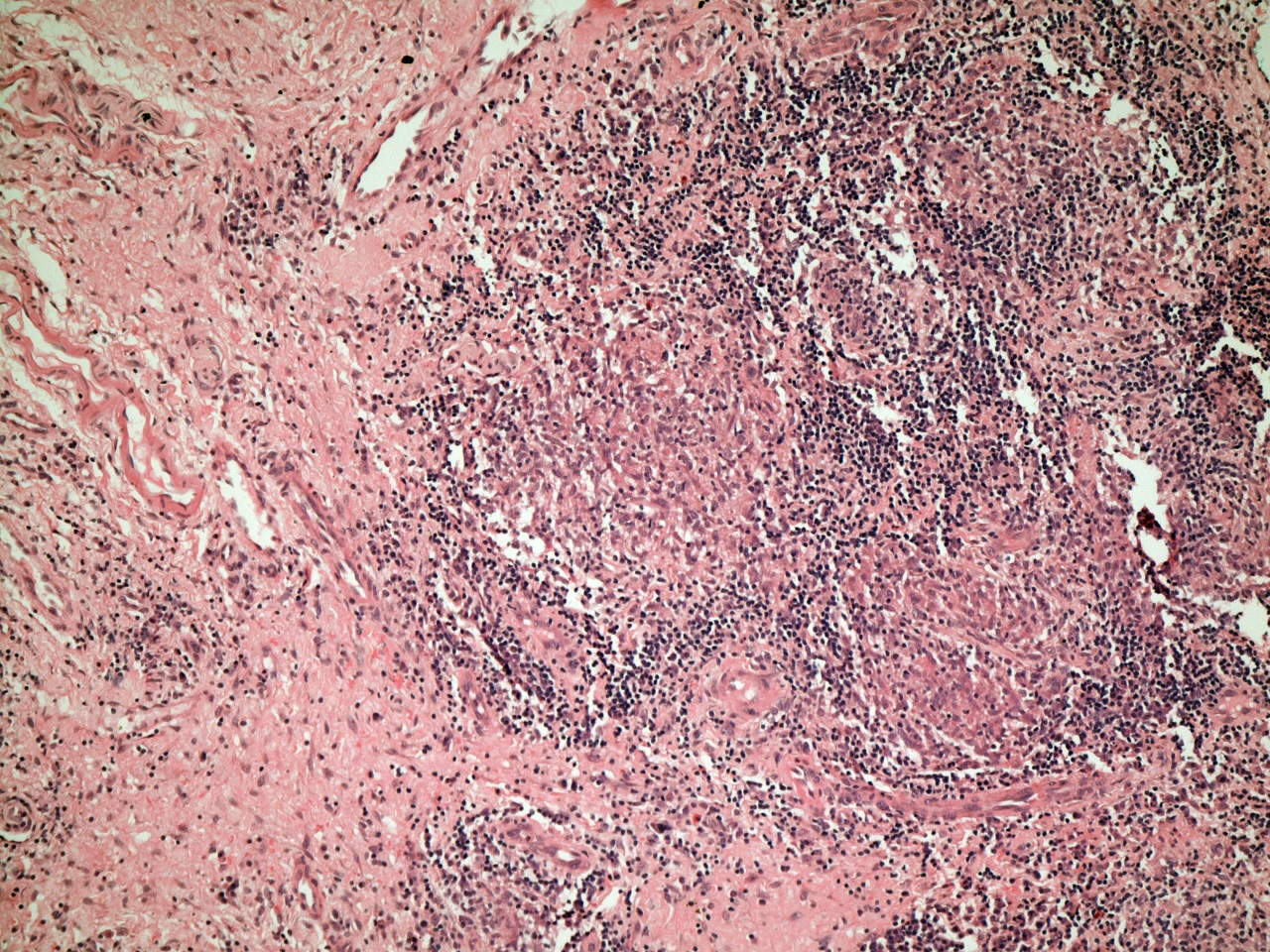 Granuloma with lymphocytes