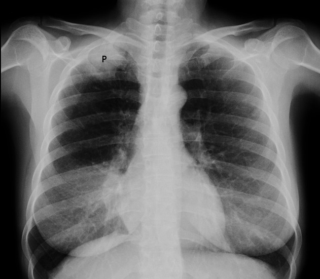Chest X-ray of bronchial carcinoma