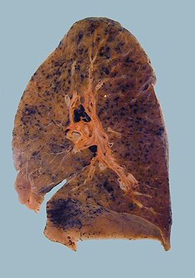 A normal lung