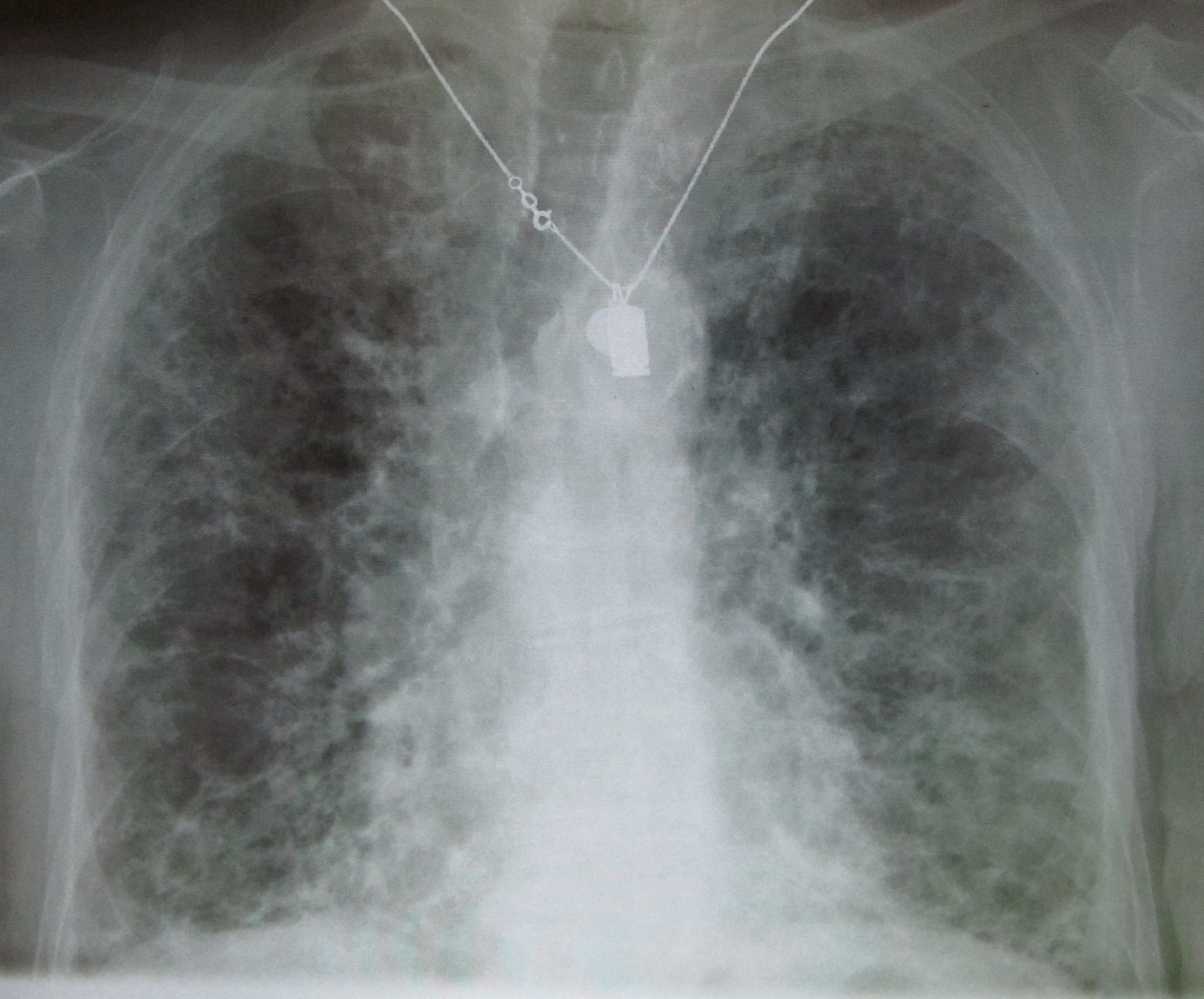 Chest X-ray of pulmonary fibrosis