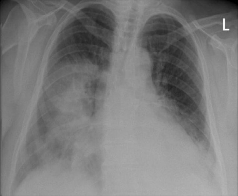 Right middle and lower lobe pneumonia