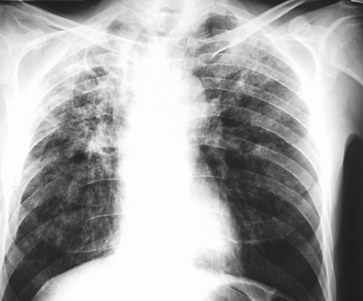 Chest X-ray of tuberculosis